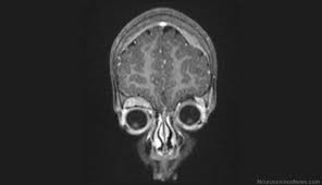 neuro skull